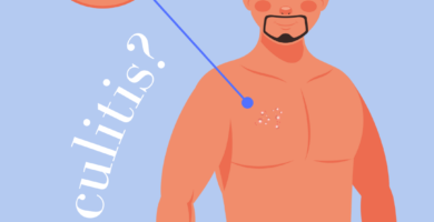 Folliculitis
